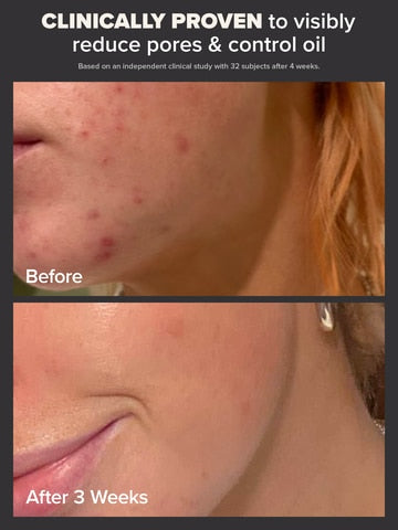 PAULA’S CHOICE Skin Perfecting 2% BHA Liquid Exfoliant