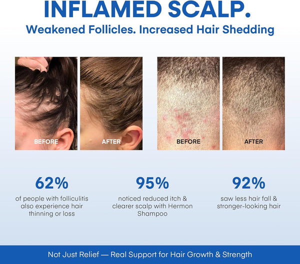 HERMON Folliculitis Relief Shampoo