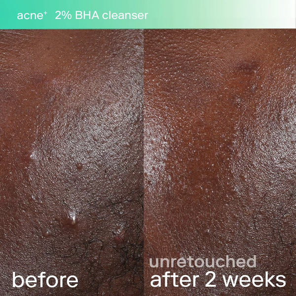 SKINFIX 2% Bha Cleanser