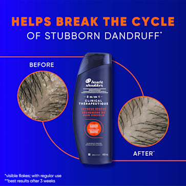 HEAD & SHOULDERS 2 in 1 Clinical Strenght Dry Scalp Rescue