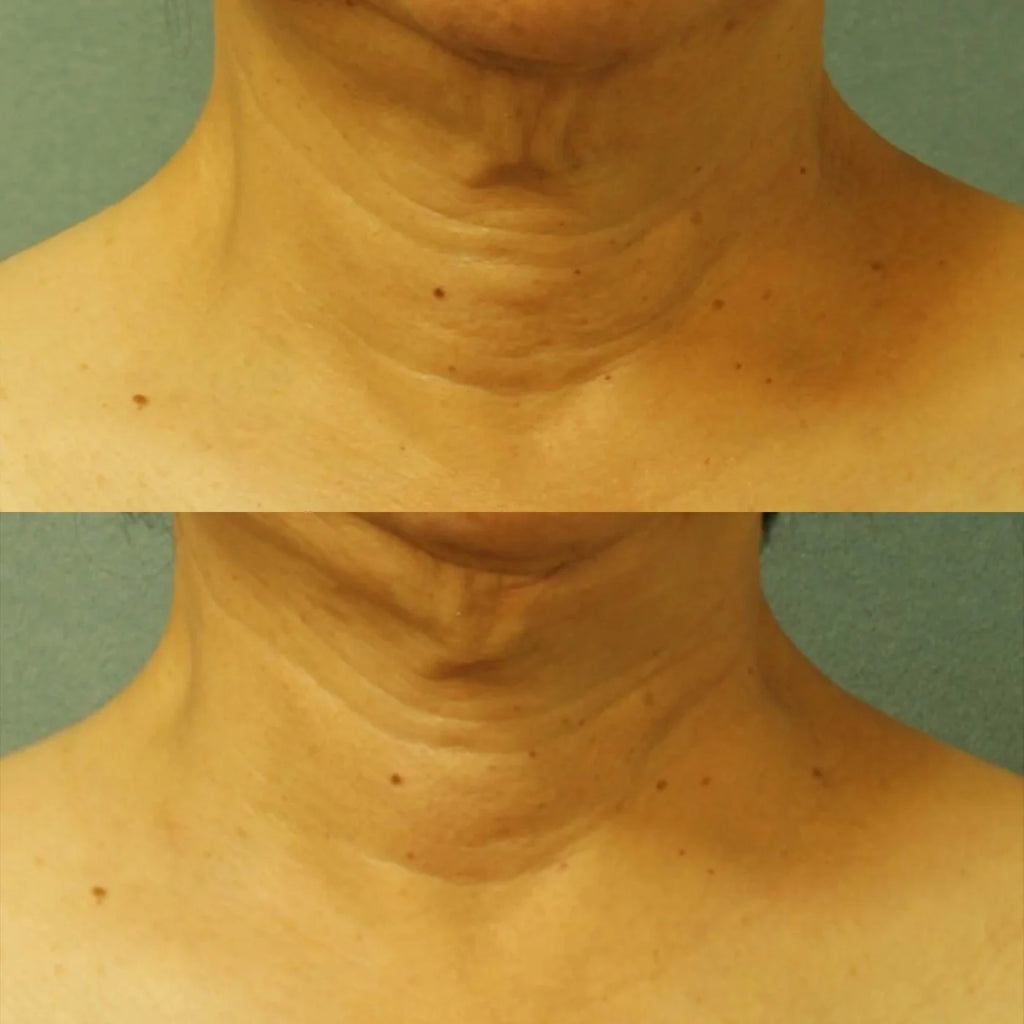 PERRICONE MD Cold Plasma Plus+ Neck & Chest Broad Spectrum SPF 25