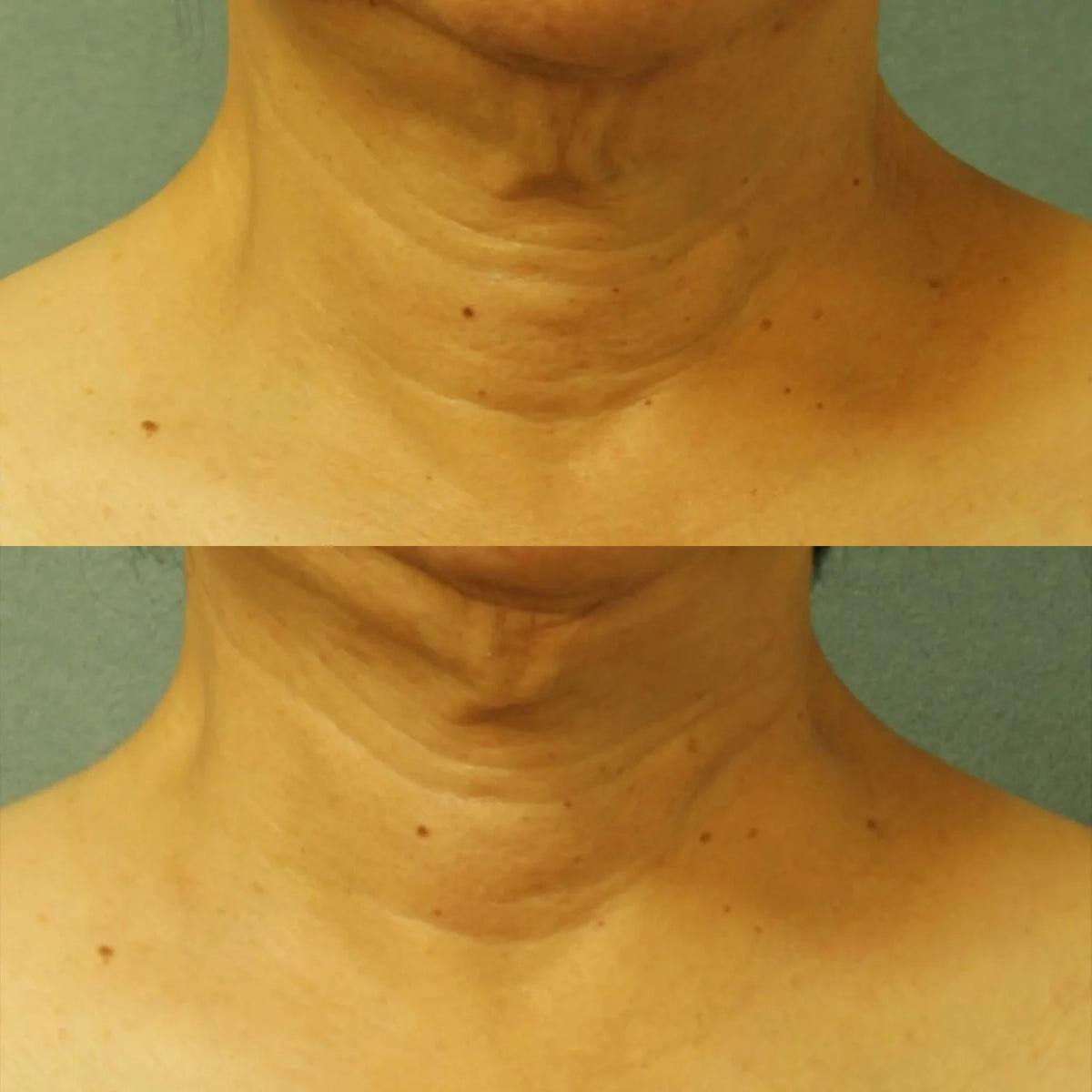 PERRICONE MD Cold Plasma Plus+ Neck & Chest Broad Spectrum SPF 25